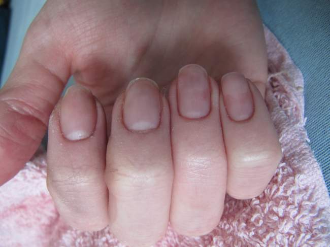 Die hellen Flecken an den Spitzen der Nägel sind nur Reste einer Modellage  Vergrößerte Nagelmonde, Fußnagelwachstum stagniert in Nagelkrankheiten