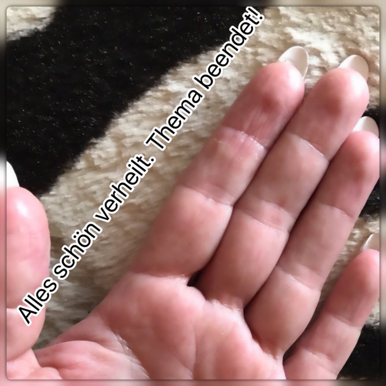 Finger Fingerkuppen reißen auf / Juckreiz - was kann das sein? in Nagelkrankheiten