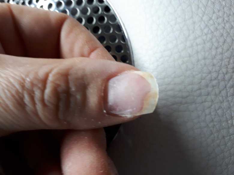 Nagelablösung Hiiilfe!Was ist das?Nägel löst sich vom Nagelbett  in Nagelkrankheiten