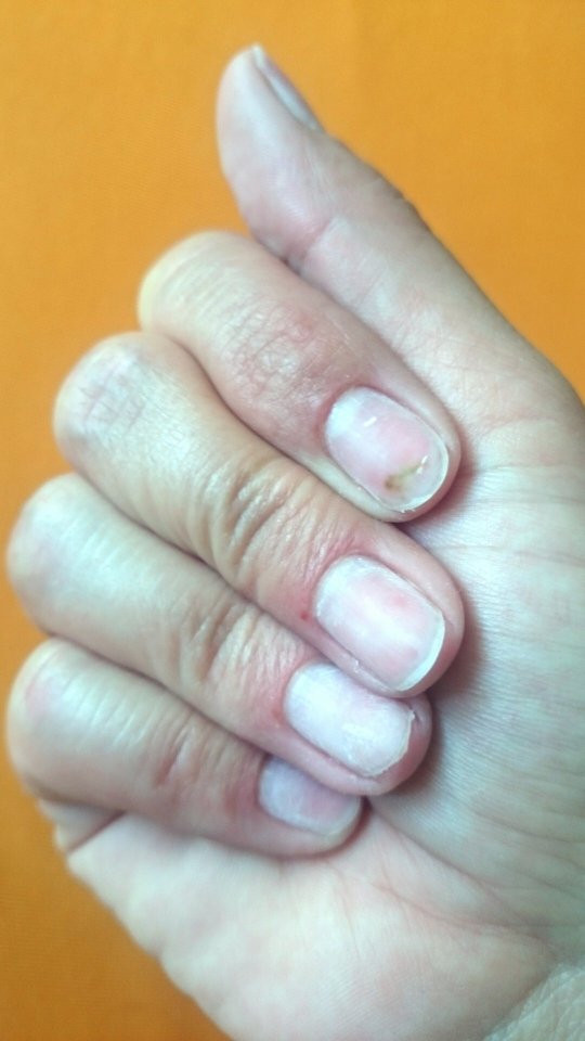 2016_06_10 Grüner Nagel unter Kunstnägeln in Nagelkrankheiten