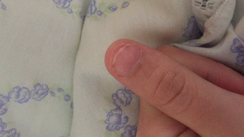 Sehr kurzer nagel Nach 2 Monaten Naturnagel kapput mit Wölbung im Nagel in Gelnägel