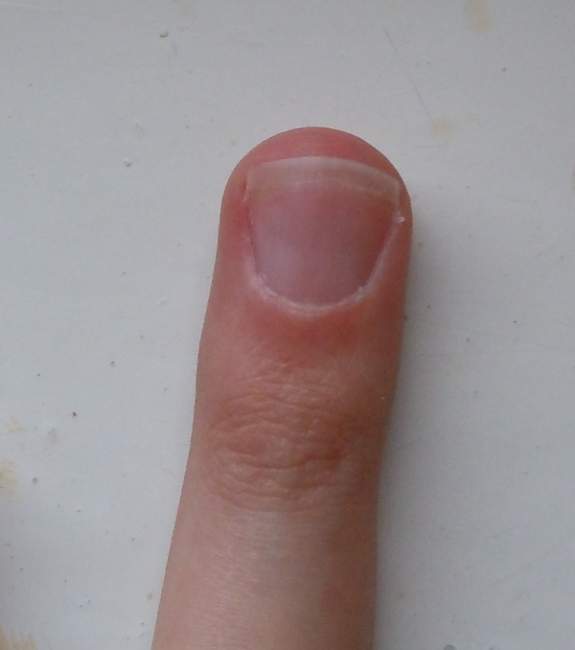 Ringfinger, kurzes Nagelbett Kurzes Nagelbett - Frage dazu in Nägel kauen