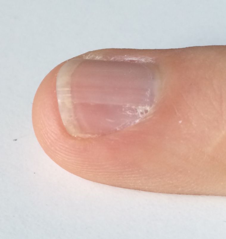 Seitenansicht: Rillen sind relativ tief Tiefe Rillen am Nagel des Mittelfingers in Nagelkrankheiten