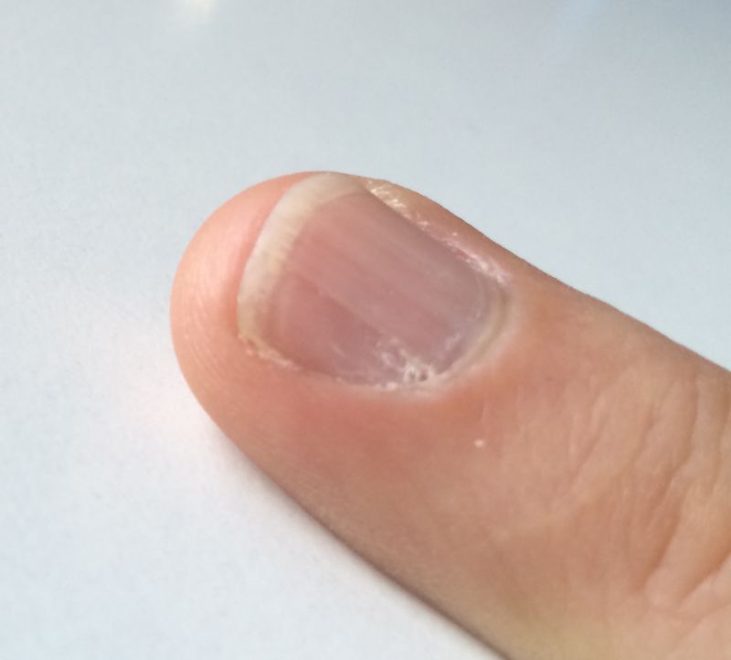 Hautschuppen, die mit der Rille herauswachsen Tiefe Rillen am Nagel des Mittelfingers in Nagelkrankheiten