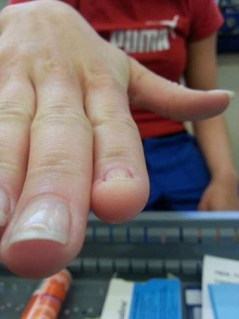 Zeigefinger Fehlender Fingernagel, ist eine Modellage möglich? in Nagelkrankheiten