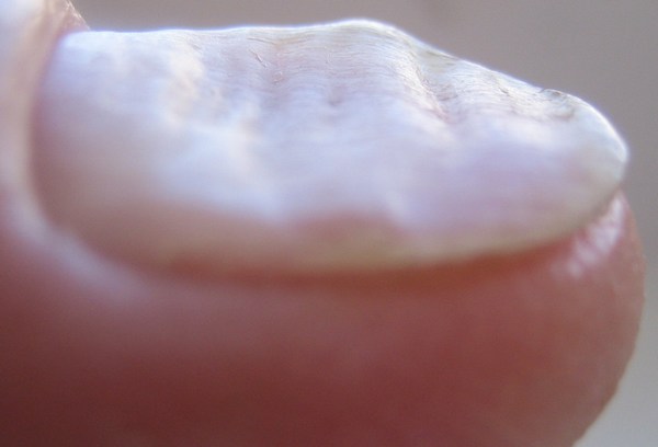 Querrillen, Dellen Schuppenflechte (Psoriasis auf Nägeln) in Nagelkrankheiten