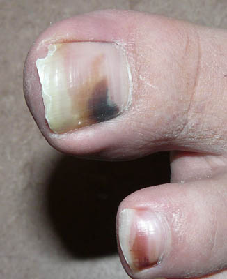 dunkle Flecken auf Zeh Dunkle Flecken auf dem Fußnagel - was ist das? in Nagelkrankheiten