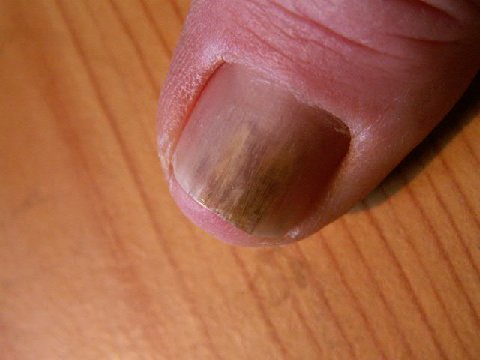 Verletzung Verletzung mit einem Holzspan (kein Pilz) in Nagelkrankheiten