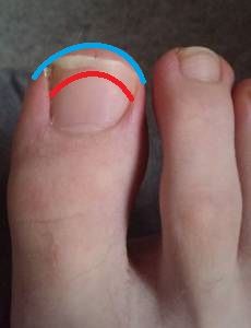 Blau = Zehenrand
Rot = Lose Nagelseite (viel zu weit)
Gezeigte Nagellänge =  Fußnagel-Pflege-Notfall in Pediküre