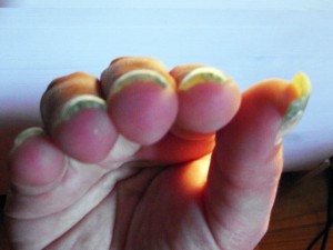 Ich habe die Nägel die Tage um ein, zwei mm gekürzt. Dadurch ist das  Nach oben wachsende Nägel, kurzes Nagelbett in Anfänger Nageldesign