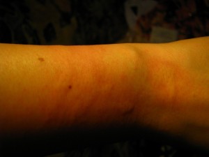 Handgelenk am linken Arm Meine Allergie auf Feilstaub (Nesselsucht) in Kosmetik / Mode