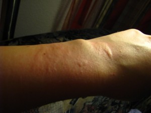 Handgelenk am linken Arm Meine Allergie auf Feilstaub (Nesselsucht) in Kosmetik / Mode