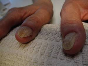 Die deformierten Daumennägel... Schlimme Nägel - zum Arzt geschickt in Nagelkrankheiten