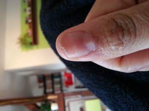 Das ist der besagte Finger Naturnagelveränderung nach Abriss der Modellage in Nagelkrankheiten