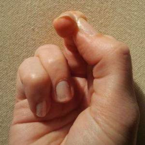 Verdickte Haut weggedrückt Problemfinger - Knubbel in Maniküre