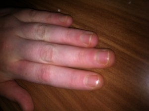 Meine Finger. Wie bekomme ich ein längeres Nagelbett? in Nägel kauen