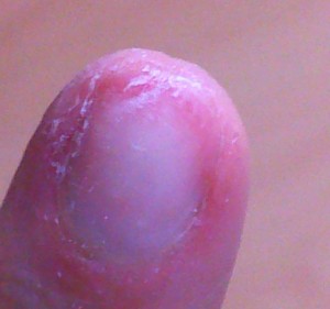 Der Zeigefinger Extrem eingerissene Naturnägel! in Nagelkrankheiten