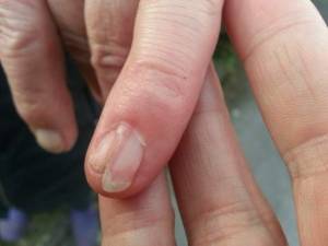 Deformierter Nagel am kleinen Finger Beschädigter Nagel - ist eine Modellage möglich? in Nagelkrankheiten