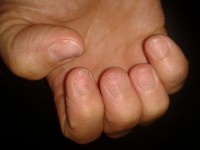 Brüchige Fingernägel Nägel brechen immer weiter ab - was dagegen tun? in Nagelkrankheiten