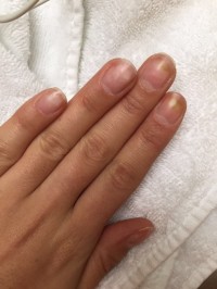 Nagelverfärbung Grüner Nagel bei einer Kundin in Nagelkrankheiten