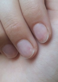 Weiße Verfärbung am Nagel Weiße Verfärbung  - Nagelpilz? in Nagelkrankheiten