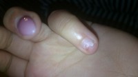 So sieht momentan mein Finger/Nagel aus Gelnagel abgebrochen  abgerissen in Gelnägel