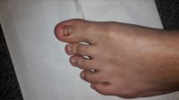 linker Fuß Kann Nagelbett sich zurückbilden? in Nagelkrankheiten