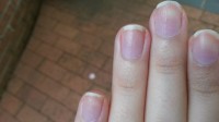 Tüpfelchen habe ich nicht auf allen Nägeln und nur an den Fingernägeln Nagelpilz oder Nagelpsorasis oder ? in Nagelkrankheiten
