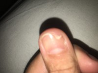 Bild von gestern Fingernagel am Daumen ab - gruselig! in Nagelkrankheiten
