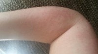 Li Arm Trotz Allergiker Gel Blasen an den Fingern in Nagelkrankheiten