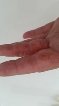 Finger links Trotz Allergiker Gel Blasen an den Fingern in Nagelkrankheiten