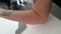 Re Arm Trotz Allergiker Gel Blasen an den Fingern in Nagelkrankheiten