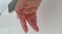 Finger rechts Trotz Allergiker Gel Blasen an den Fingern in Nagelkrankheiten