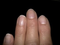 Die drei Finger sind ziemlich mitgenommen Ist eine einfache Nagelverstärkung möglich? in Nagelmodellagen