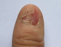 Daumen Fingernagel am Daumen ab - gruselig! in Nagelkrankheiten
