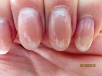 Lösung der Nagelplatte des kleinen Fingers 3. Ablösung des Naturnagels unter der Modellage in Nagelkrankheiten