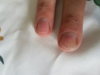 Mittelfinger Nagelbett schmerzt in Nagelkrankheiten