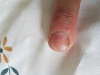 Immer verfärbt Nagelbett schmerzt in Nagelkrankheiten
