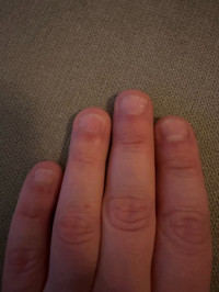 Hand1 Wie soll sich das nagelbett erholen in Nägel kauen