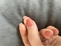 2 Überschüssige Haut unter Nagel in Nagelkrankheiten