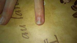 Fingernagel: hohl und darin sammelt sich nun Schmutz! Ist das Nagelpilz? in Nagelkrankheiten