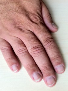 kamera: iPhone 4 Künstliche Nägel bei männlichen Nägelkauern in Nägel kauen