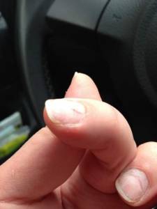 So sah der Finger gestern aus nach der Behandlung ... Pflegetips,zu weit runtergefeilte Nägel gesucht in Nageldesign