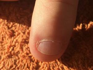 Ein Finger, wie er vorher aussah Nagelbeisser (mein Mann) Fingernägel gemacht in Nägel kauen
