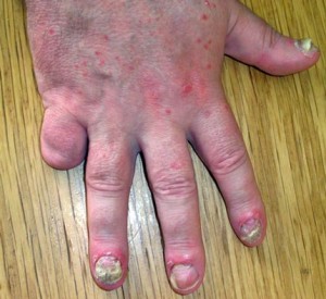 Quelle: www.psoriasis-netz.de Schuppenflechte (Psoriasis auf Nägeln) in Nagelkrankheiten