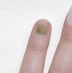  Grüner Nagel unter Kunstnägeln in Nagelkrankheiten