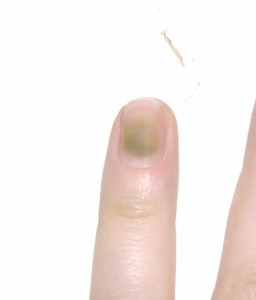  Grüner Nagel unter Kunstnägeln in Nagelkrankheiten