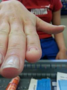 Zeigefinger Fehlender Fingernagel, ist eine Modellage möglich? in Nagelkrankheiten