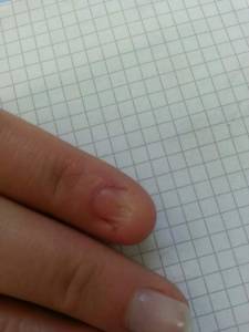 Zeigefinger rechts Fehlender Fingernagel, ist eine Modellage möglich? in Nagelkrankheiten