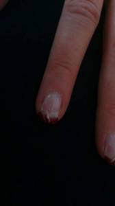 der weisse fleck ist links zu sehen! a manch anderen fingern sieht es eher wie  auf einmal milchige flecken!? in Nagelkrankheiten